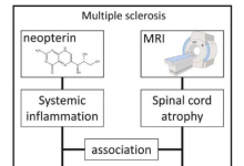 多发性硬化症进展与大脑外的免疫反应有关