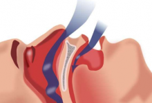 阻塞性睡眠呼吸暂停可能会增加腹主动脉瘤的风险