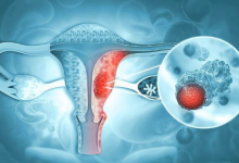 派姆单抗可提高高危子宫内膜癌患者的生存率