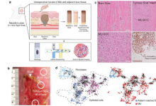 研究人员利用基因组技术研究与烧伤疤痕相关的侵袭性皮肤癌